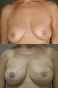 breast-reconstruction-and-tissue-expanders-p22.jpg