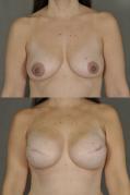 breast-reconstruction-and-tissue-expanders-p24.jpg