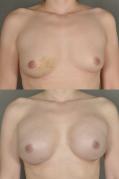 breast-reconstruction-and-tissue-expanders-p25.jpg