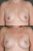 breast-reconstruction-and-tissue-expanders-p26.jpg