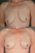 breast-reconstruction-and-tissue-expanders-p27.jpg