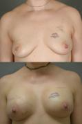 breast-reconstruction-and-tissue-expanders-p29.jpg