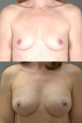 breast-reconstruction-and-tissue-expanders-p3.jpg