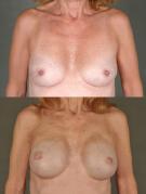 breast-reconstruction-and-tissue-expanders-p30.jpg