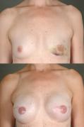 breast-reconstruction-and-tissue-expanders-p31.jpg
