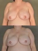 breast-reconstruction-and-tissue-expanders-p32.jpg