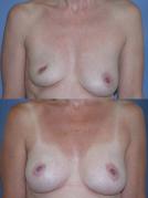 breast-reconstruction-and-tissue-expanders-p34.jpg