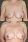 breast-reconstruction-and-tissue-expanders-p37.jpg