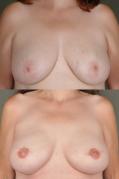 breast-reconstruction-and-tissue-expanders-p39.jpg