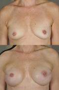 breast-reconstruction-and-tissue-expanders-p4.jpg