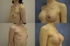 breast-reconstruction-breast-implant-g4.jpg
