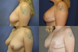 breast-reconstruction-breast-implants-g8.jpg