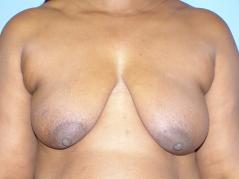 breast-reconstruction-p10.jpg