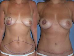 breast-reconstruction-tram-p2_bqBkAuk.jpg