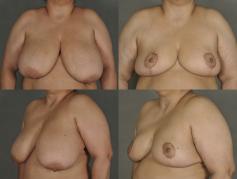 breast-reduction-p12.jpg