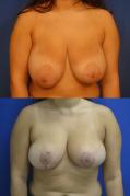 breast_reduc_3.jpg