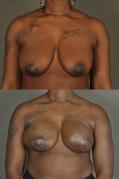 latissimus-flap-breast-reconstruction-p2.jpg