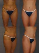 liposuction-p4.jpg