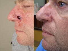 mohs-surgery-and-reconstruction-p1.jpg