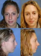 nose-rhinoplasty-p3.jpg