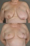 oncoplastic-breast-reduction-p4.jpg
