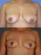 tram-flap-breast-reconstruction-and-tummy-tuck-p1_OwsiV7w.jpg