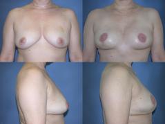 tram-flap-breast-reconstruction-p14.jpg