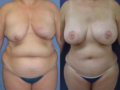 tram-flap-breast-reconstruction-p19_M553RIW.jpg