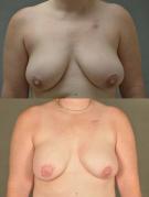 tram-flap-breast-reconstruction-p27.jpg