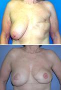 tram-flap-breast-reconstruction-p31.jpg