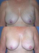 tram-flap-breast-reconstruction-p32_SqCaiDf.jpg
