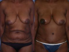 tram-flap-breast-reconstruction-p6.jpg