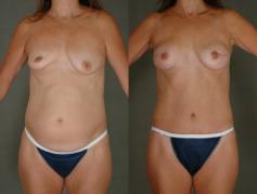 tram-flap-breast-reconstruction-p7.jpg