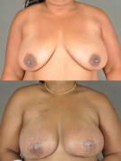 tram-flap-breast-reconstruction-p8.jpg