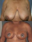tram-flap-breast-reconstruction-p9.jpg