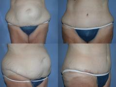 tummy-tuck-and-liposuction-p10.jpg