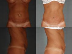 tummy-tuck-and-liposuction-p4.jpg