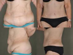 tummy-tuck-and-liposuction-p7.jpg