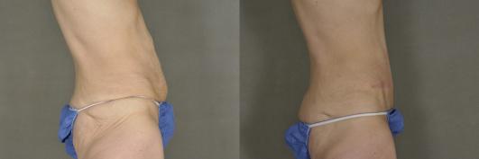 Abdominoplasty (tummy tuck) and body contouring after massive weight loss