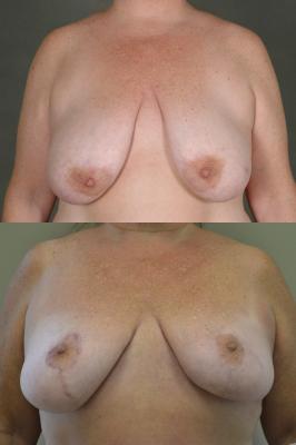 Oncoplastic breast reduction