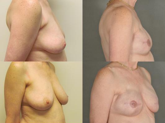 Bilateral expander breast reconstruction