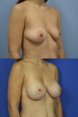 Bilateral expander breast reconstruction 