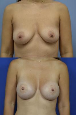 Bilateral expander breast reconstruction 