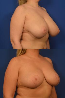 Bilateral Breast Reduction 