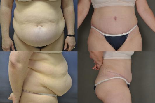 Tummy Tuck