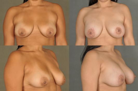 Breast Augmentation 