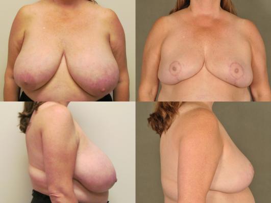 patient in her 40s with large breasts who underwent bilateral breast reduction
