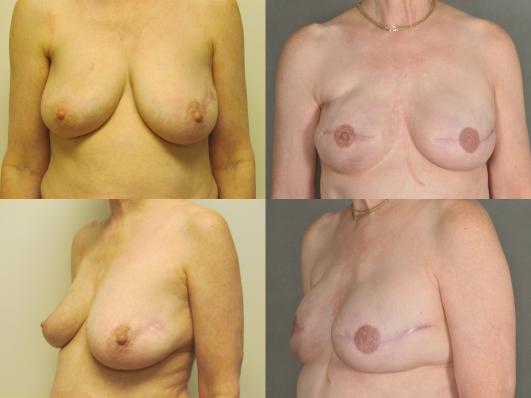 Patient in her 40s with preexisting L breast scar,who underwent bilateral skin sparing mastectomy and implant reconstruction