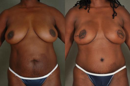 bilateral mastectomy and DIEP flap reconstruction