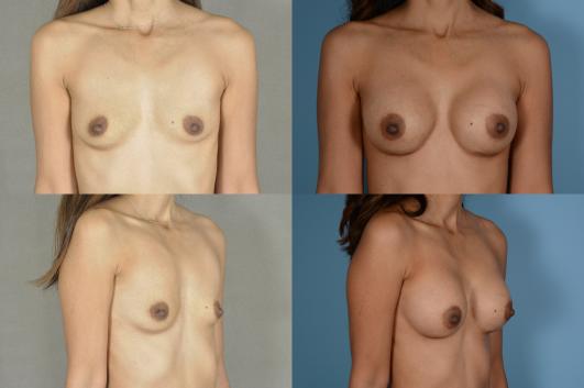 Breast Augmentation 
